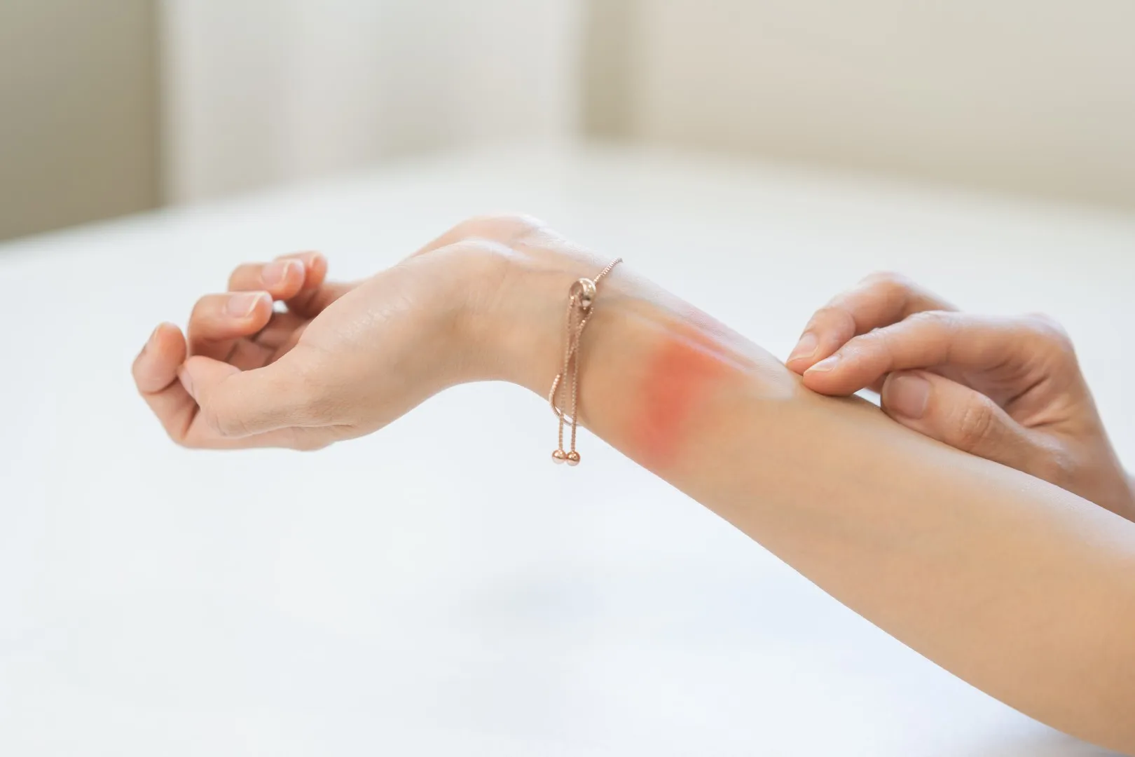 Red rash on wrist showing possible workplace chemical exposure, representing environmental and occupational disease injury claims in California.